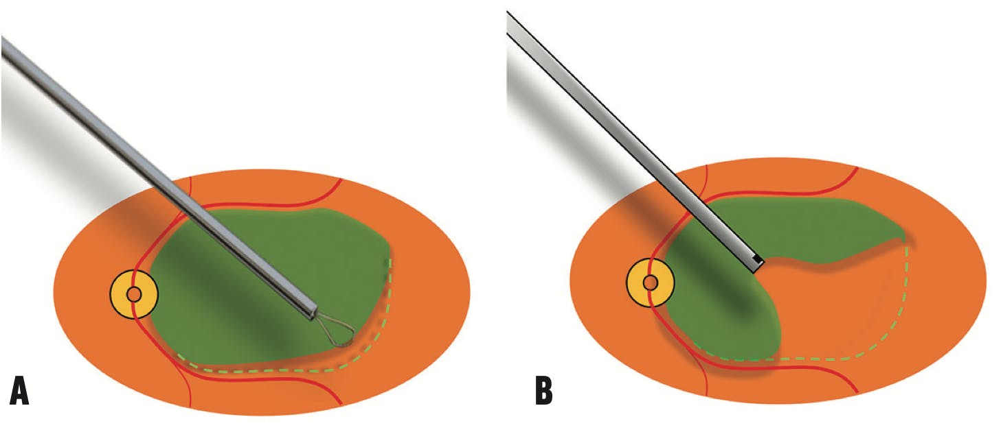 No More Forceps: A Cutter-based Approach to ILM Peeling - Retina